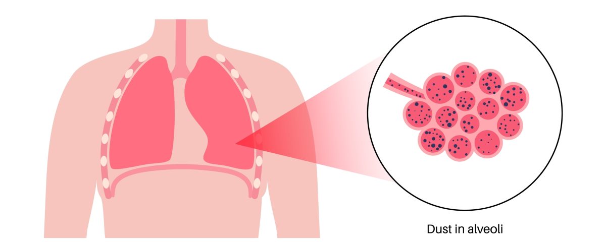 Silicosis Lawsuit Silica Lung Diseases