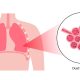 Silicosis Lawsuit Silica Lung Diseases