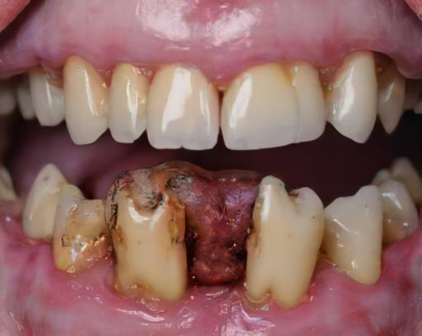 Suboxone tooth decay